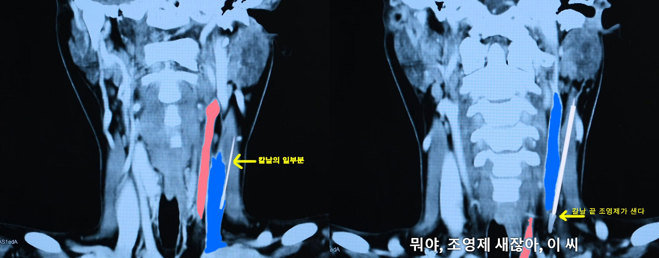 Pt_Head_CT_00.jpg
