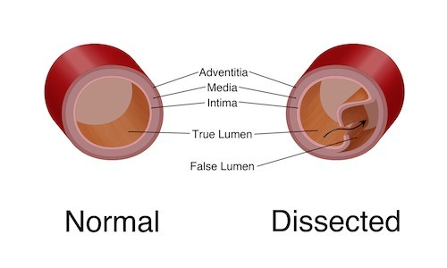 Aortic Dissection.jpg