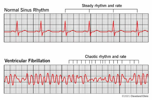 21878-ventricular-fibrillation-illustration.jpg