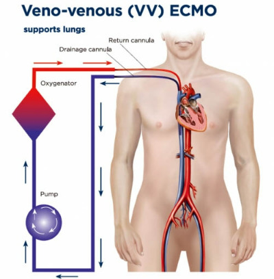 VV_ECMO.jpg