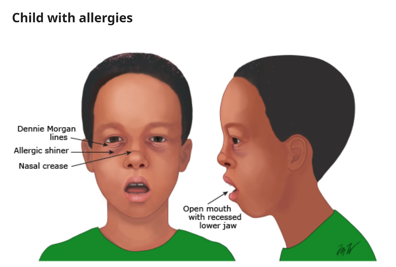 비염 얼굴 변형.jpg