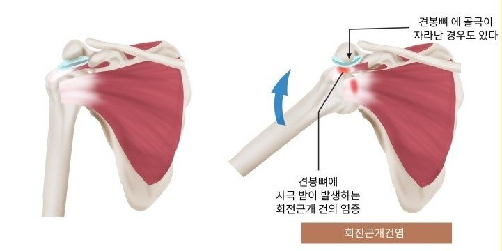 회전근개파열.jpg
