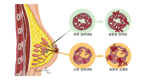 유방암 종류_국가암정보센터.jpg