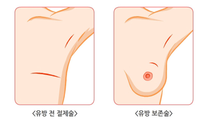 전절제vs부분절제.jpg
