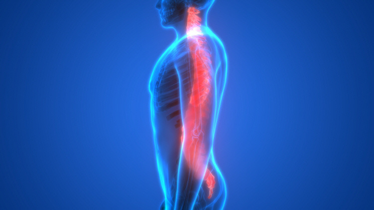 허리 디스크 2.jpg