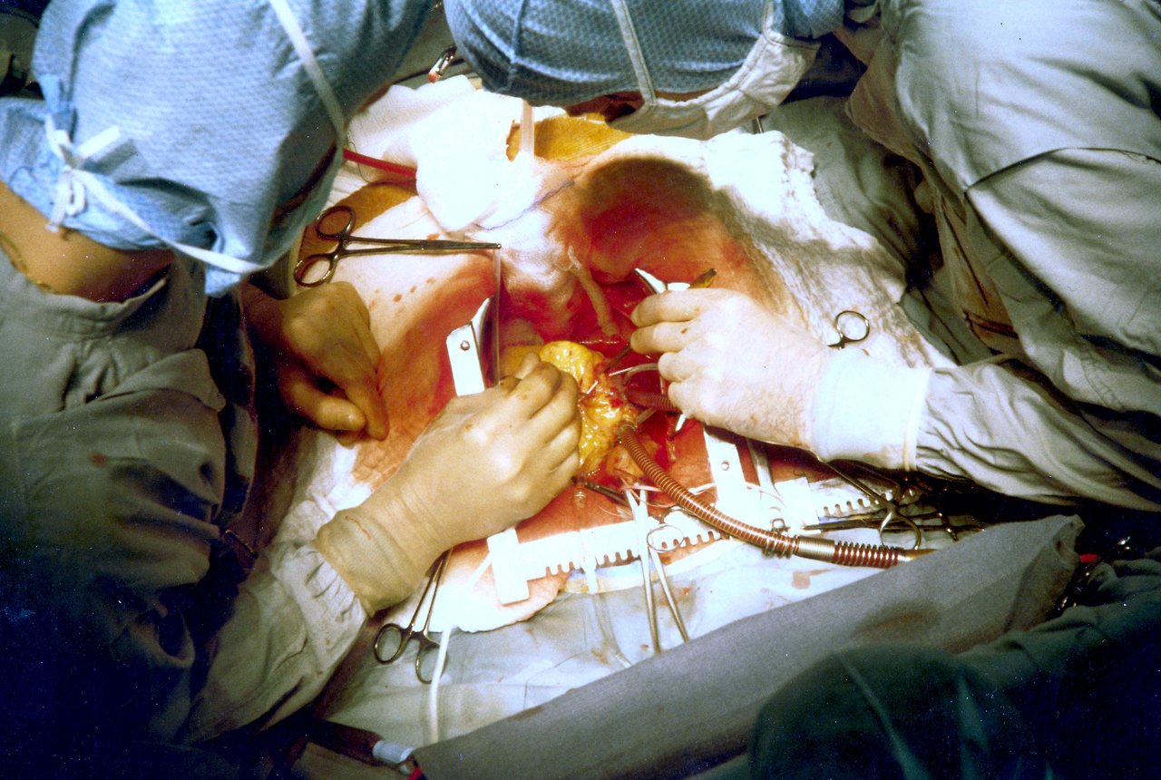 Coronary_artery_bypass_surgery_Image_657B-PH.jpg
