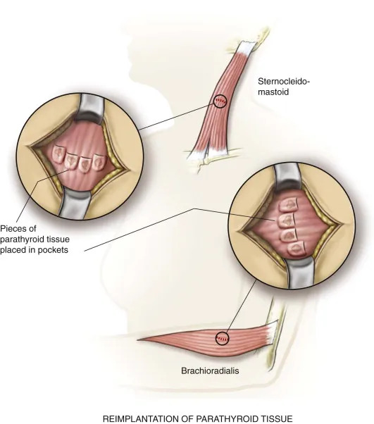 PT autotrnasplant.jpg