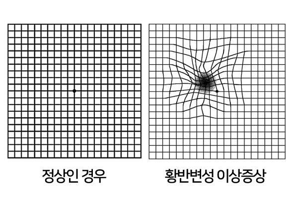 황반변성 2.jpg