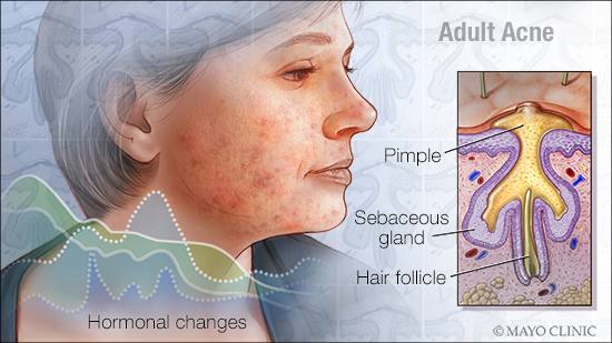a-medical-illustration-of-adult-acne-original (1).jpg