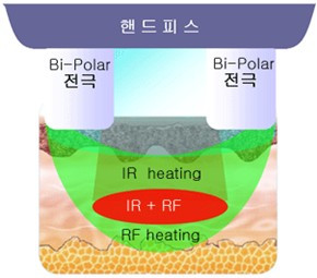 폴라리스 전극.jpg