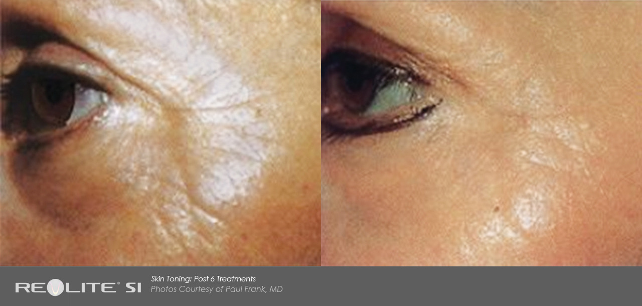 레블라이트 전후.jpg