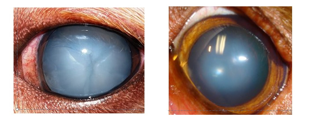 백내장, 핵경화증.jpg