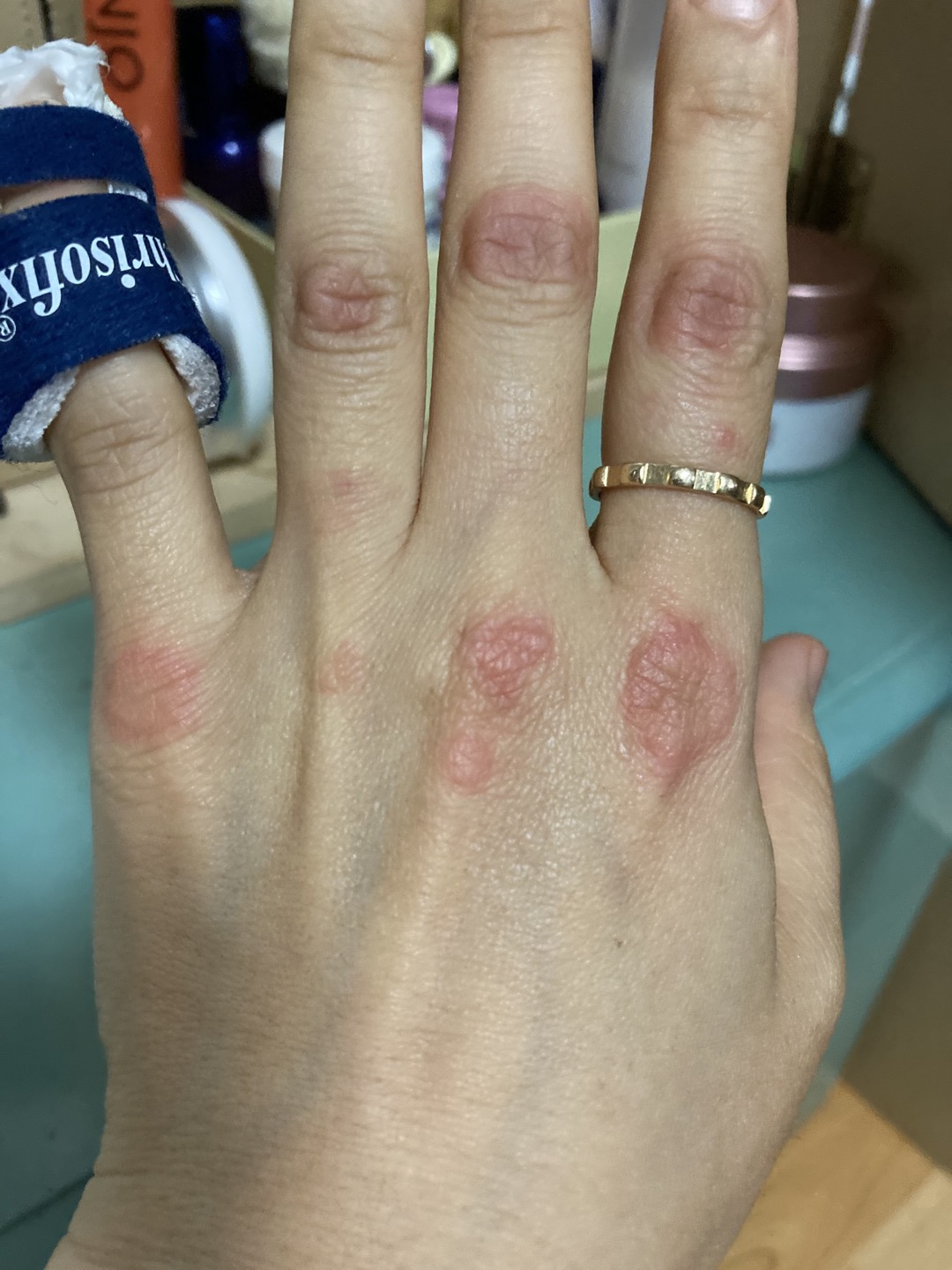 망치수지 & 다형홍반.jpg