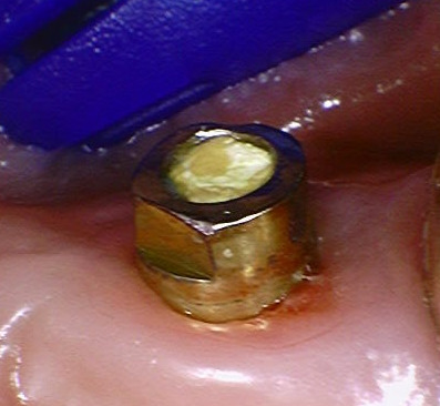 abutment.jpg
