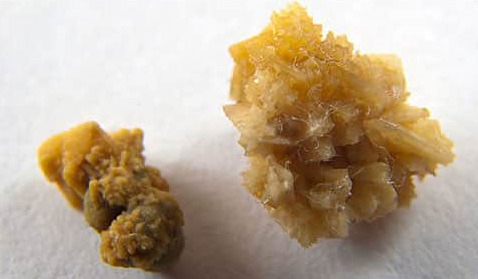 kidney-stones-1.jpg