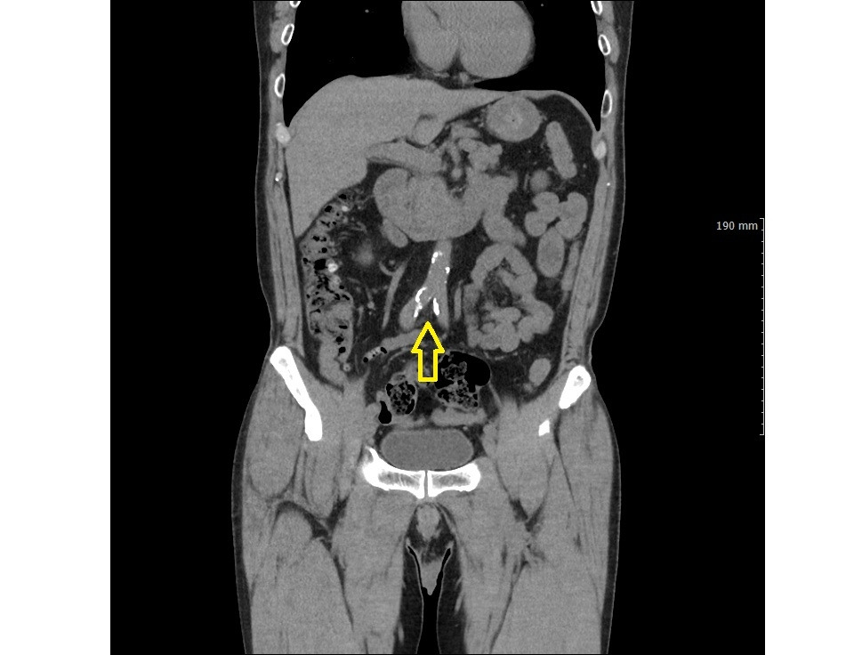 대동맥 돌 사진_46M.jpg
