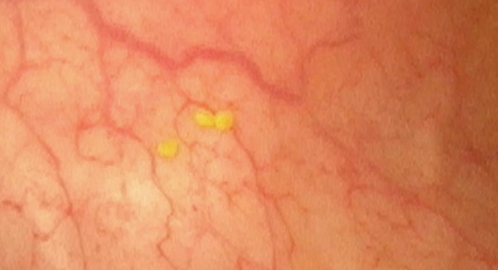 요로 결석 그림 방광내 결석들.jpg