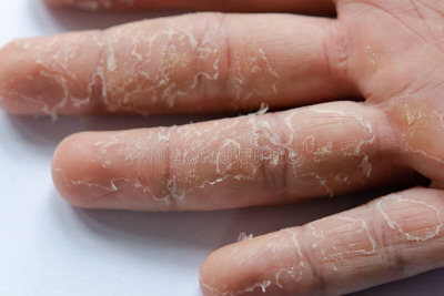 peeling-skin-hand-fingers-desquamation-peeling-skin-hand-fingers-desquamation-228819689.jpg