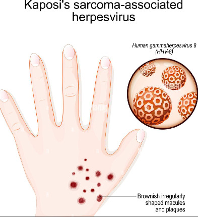 kaposis-sarcoma-associated-herpesvirus-humans-hand-with-brownish-irregularly-shaped-macules-and-plaques-close-up-of-human-gammaherpesvirus-hhv-8-2JGEHXC.jpg