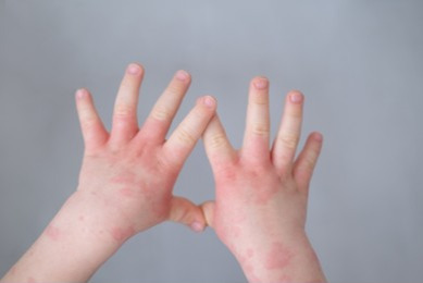 close-kids-hand-allergic-rash-260nw-2144149079.jpg