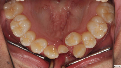 supernumerary-tooth-hypodontia.jpg