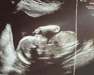 금이 초음파 사진 2.jpg