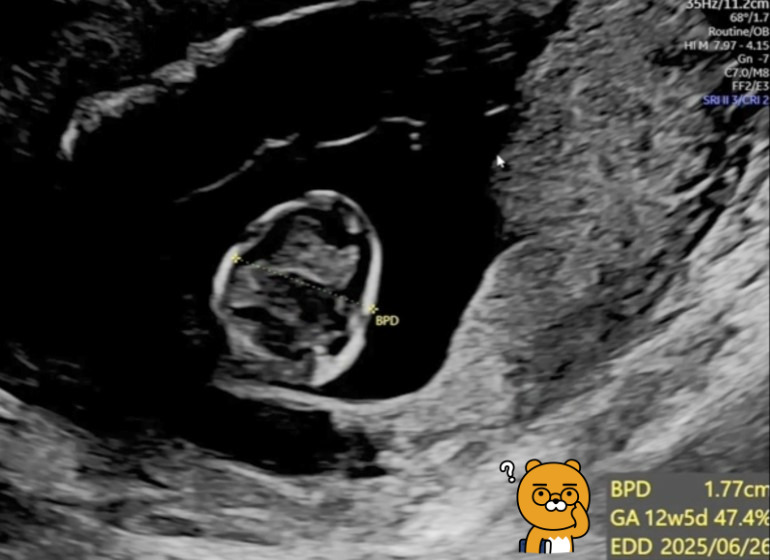 12주 태아 신체 측정.jpg