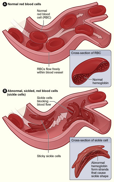 Sickle_cell_01.jpg