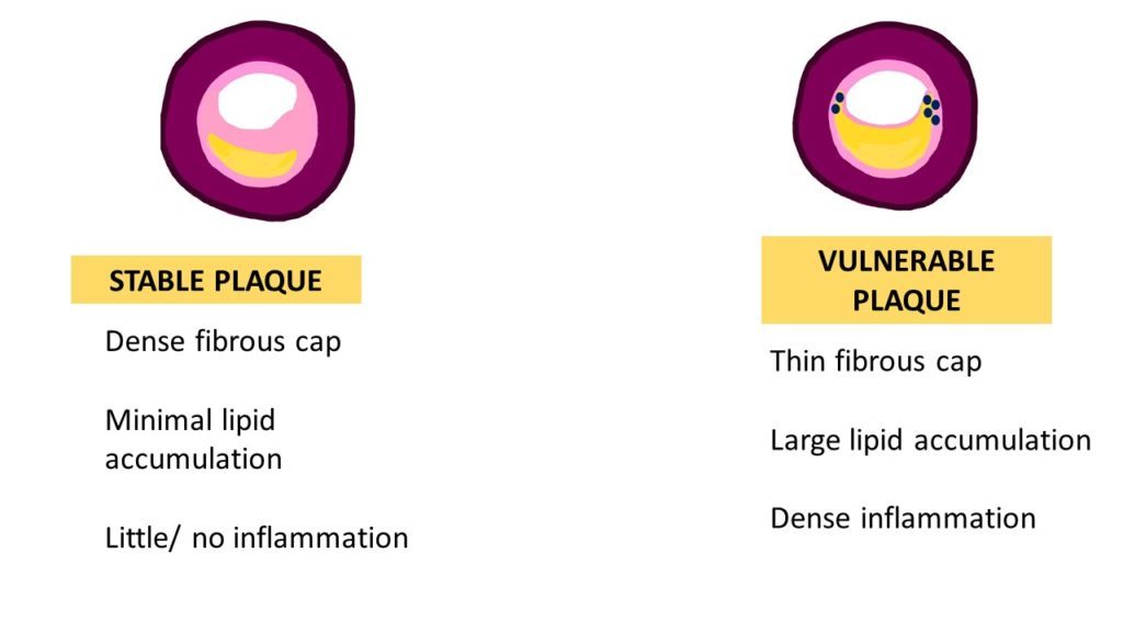 vulnerable_plaque.jpg