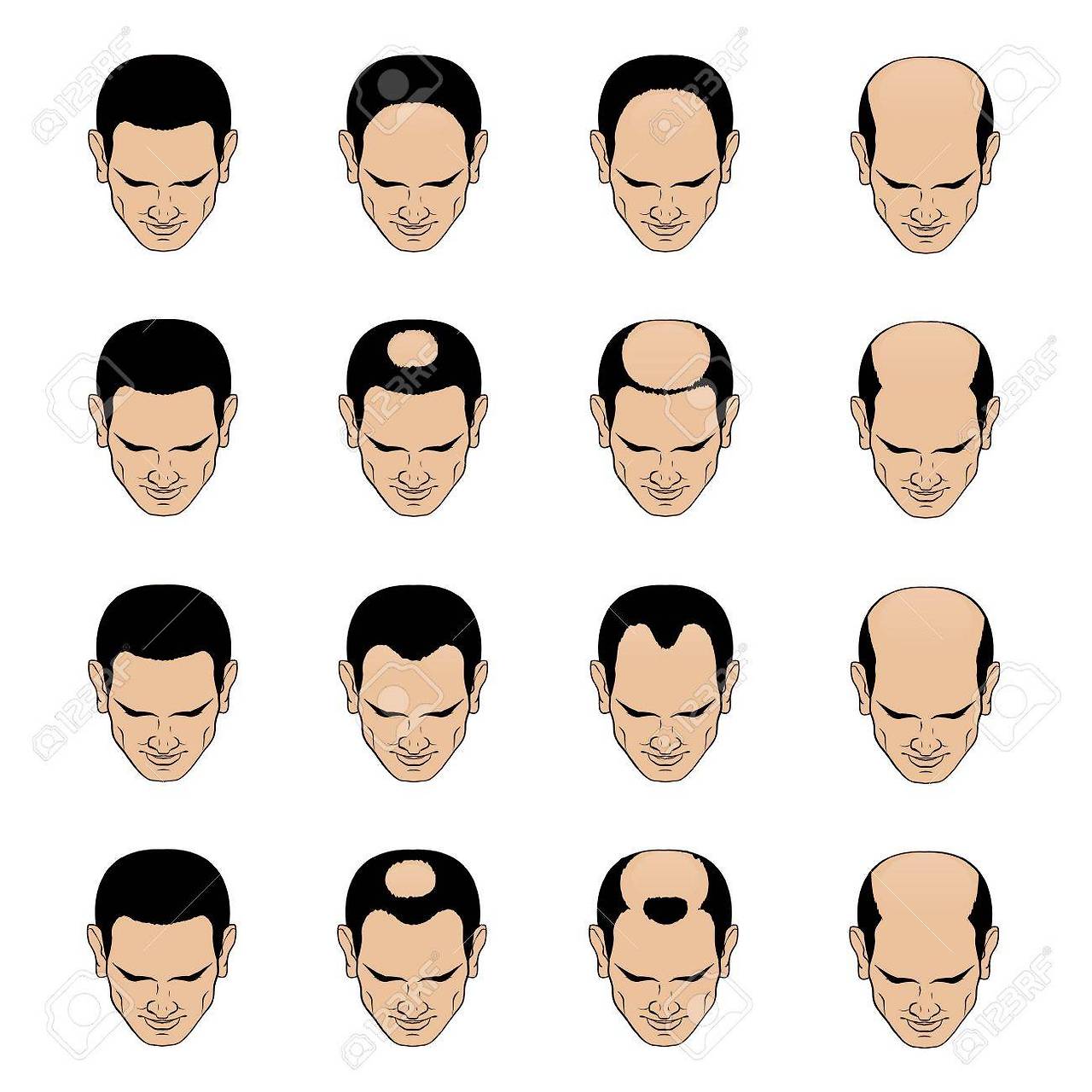 71357555-information-chart-showing-types-and-stages-of-hair-loss-for-men-bolding-head-from-full-hair-cover.jpg