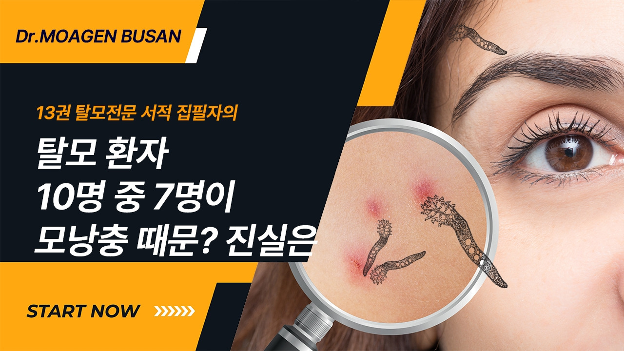 21-탈모환자 10명 중 7명이 모낭충 떄문 진실은.jpg