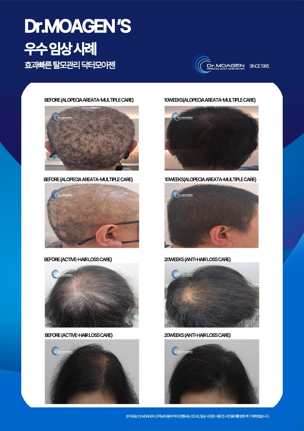 부산탈모관리.jpg