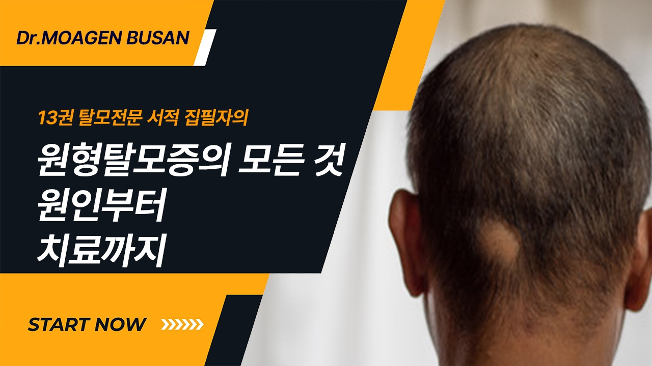 25-원형탈모증의 모든것.jpg
