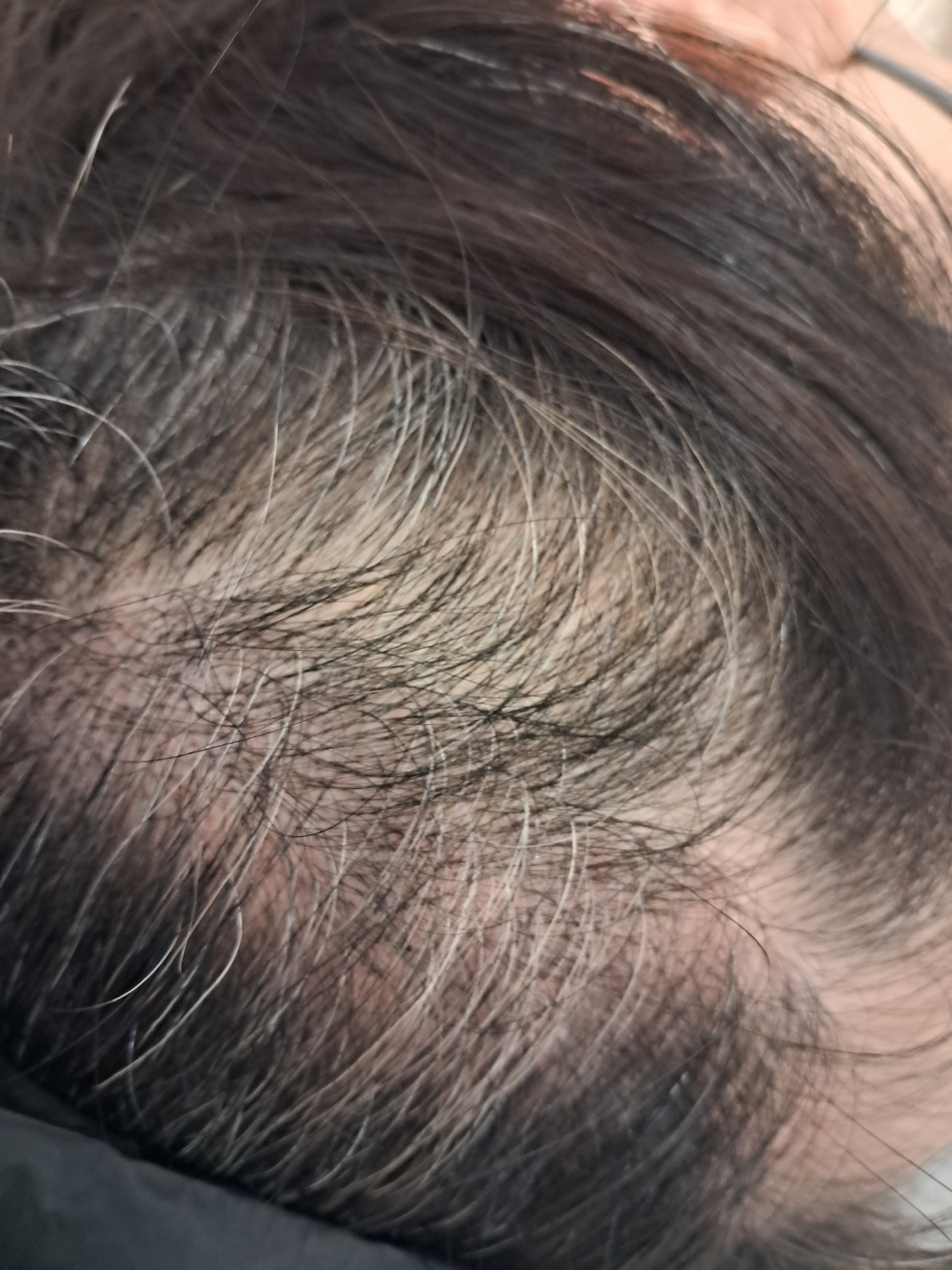 다발형 원형탈모증 원인.jpg