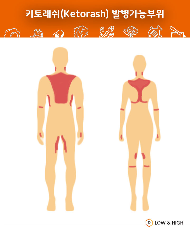 키토래쉬 발병부위2.jpg