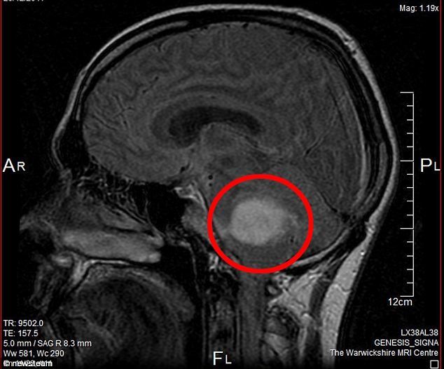 MRI-scan-brain-tumour.jpg