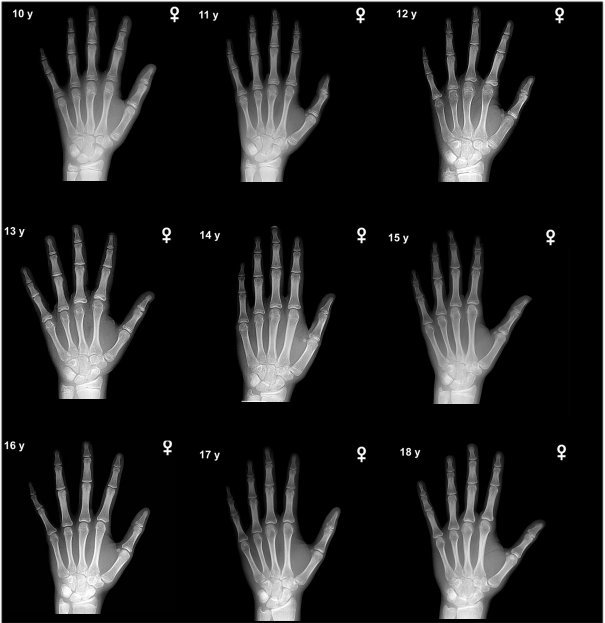 BoneAge2.jpg