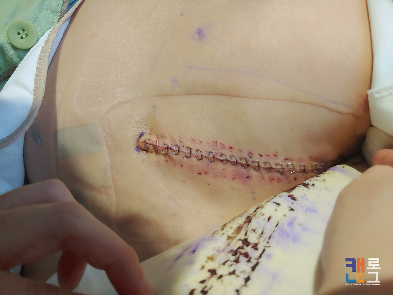 삼성서울병원_유방암수술_D+1일차_06.jpg
