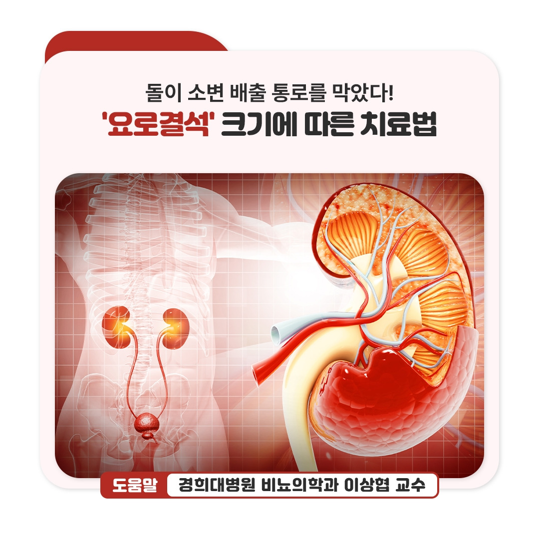 요로결석_01.jpg