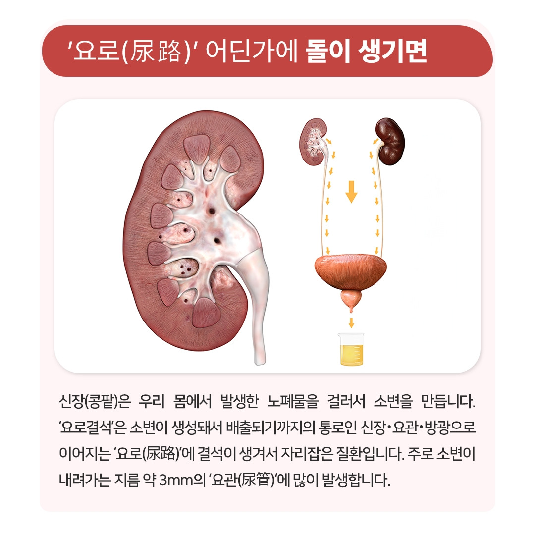 요로결석_02.jpg