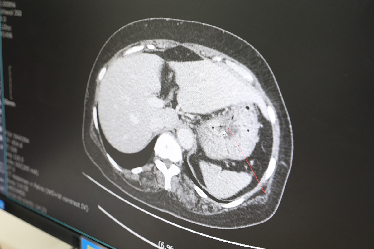 [참고자료] 위암환자 CT 사진.jpg