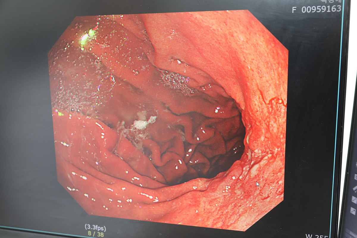 [참고자료]위암환자 내시경 사진.jpg