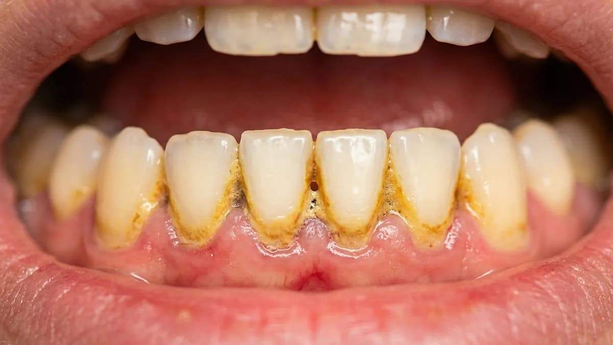 the-dangers-of-neglecting-tartar-1.jpg