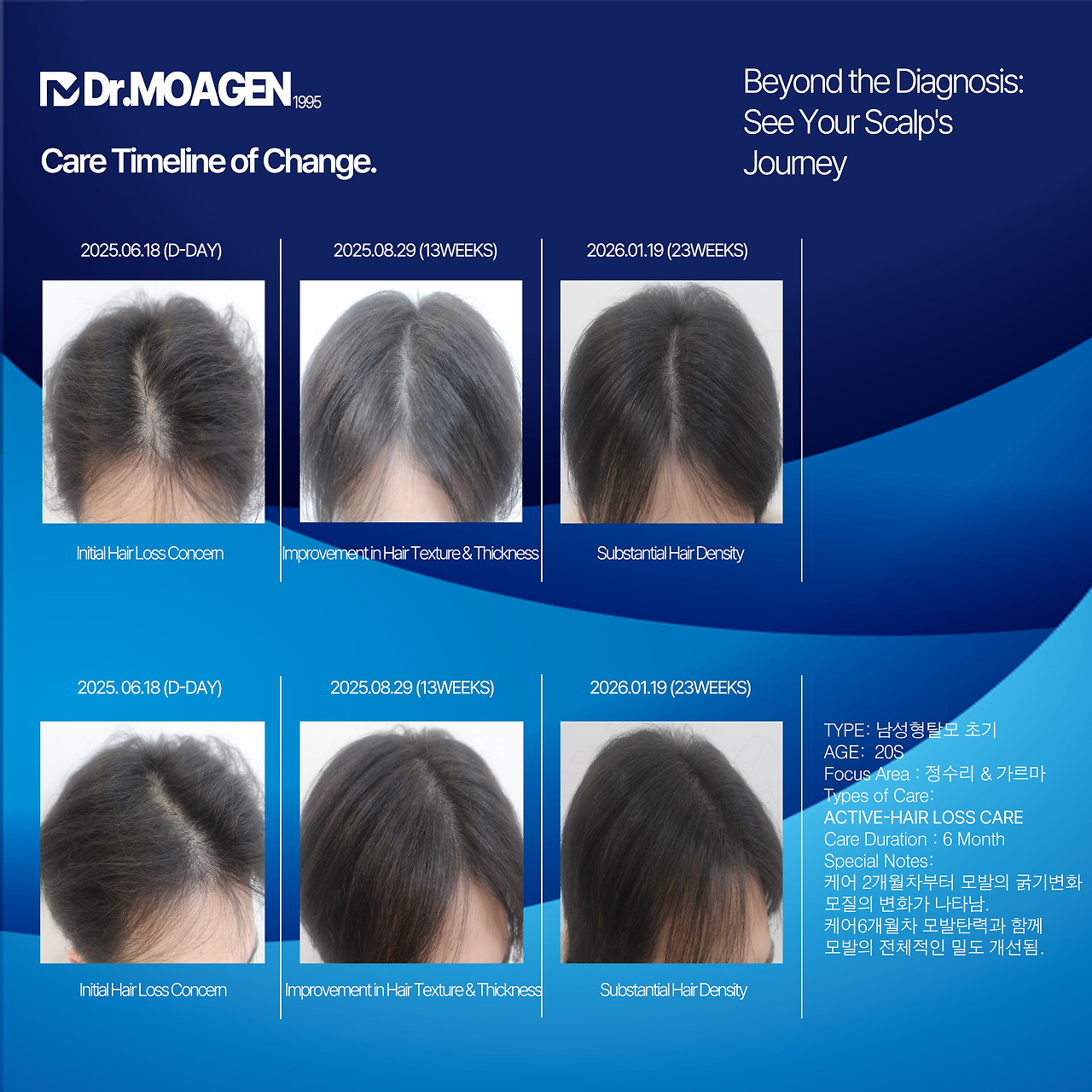 부산탈모성지 20대남성탈모.jpg