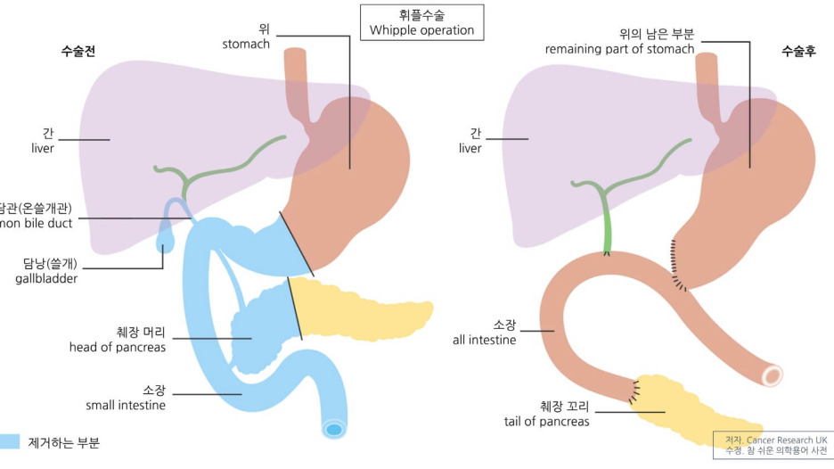 13시간 넘게 걸리는 악명 높은 췌장암 수술