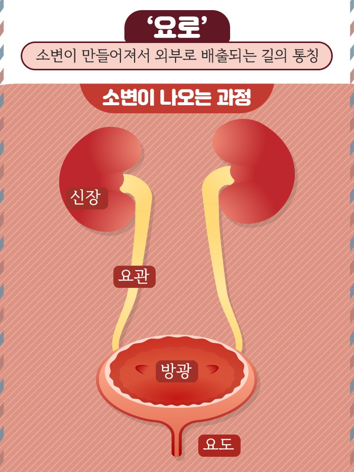 소변길 불청객 ‘요로 결석’