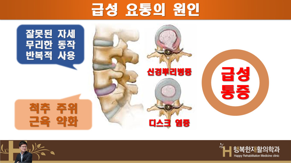 왜 당신의 요통은 사라지지 않나(2)급성요통 원인