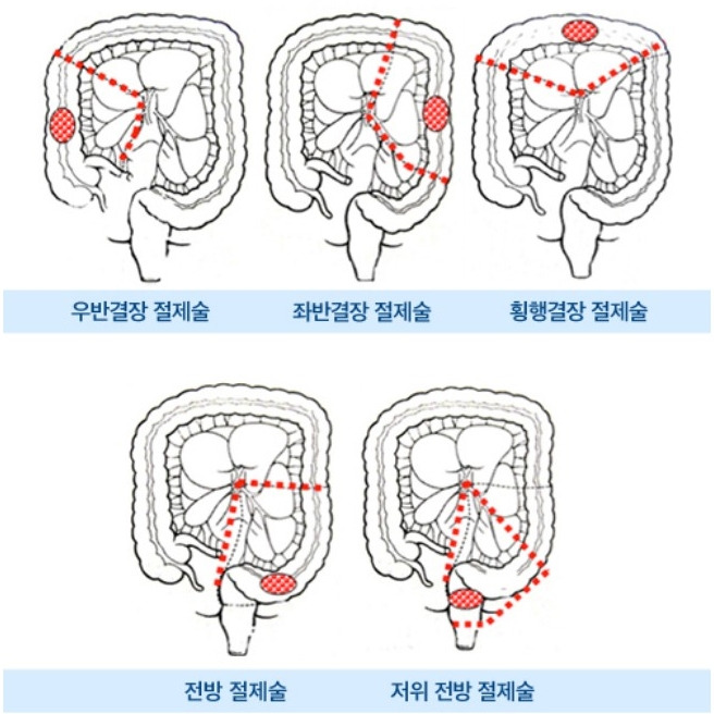 대장암 검사와 복강경 대장암수술
