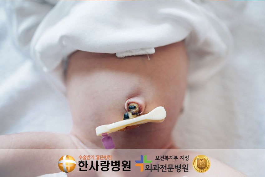 어린이 탈장 수술, 언제 해야 할까?