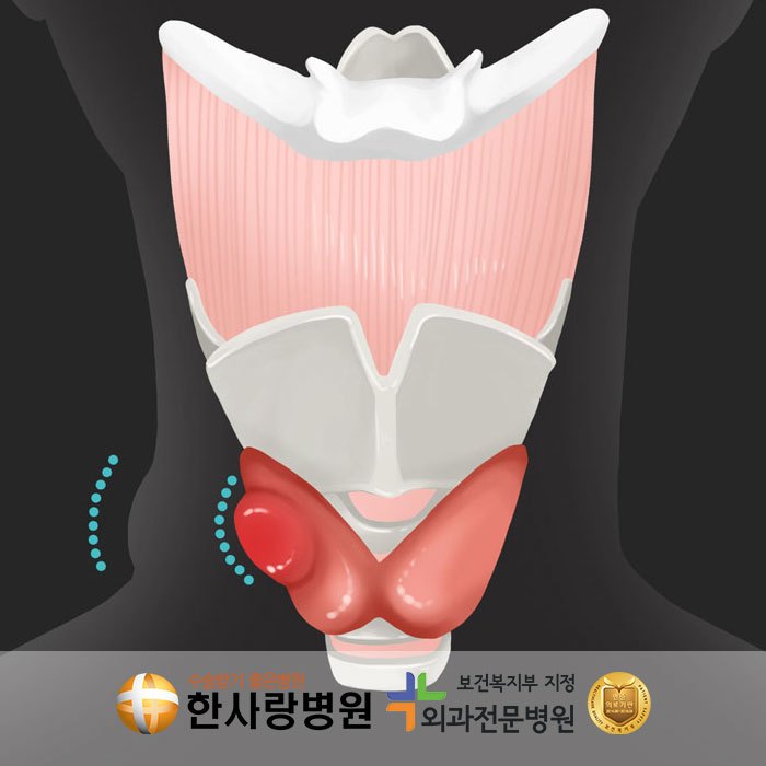 원주 갑상선 물 닿으면